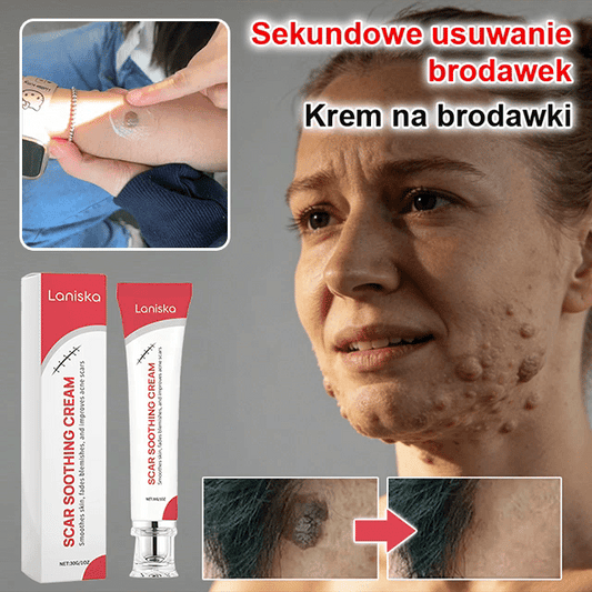 Szybko Działający Krem na Brodawki – Widoczne Efekty