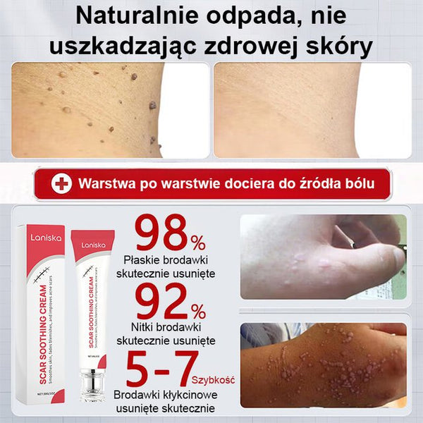 Szybko Działający Krem na Brodawki – Widoczne Efekty